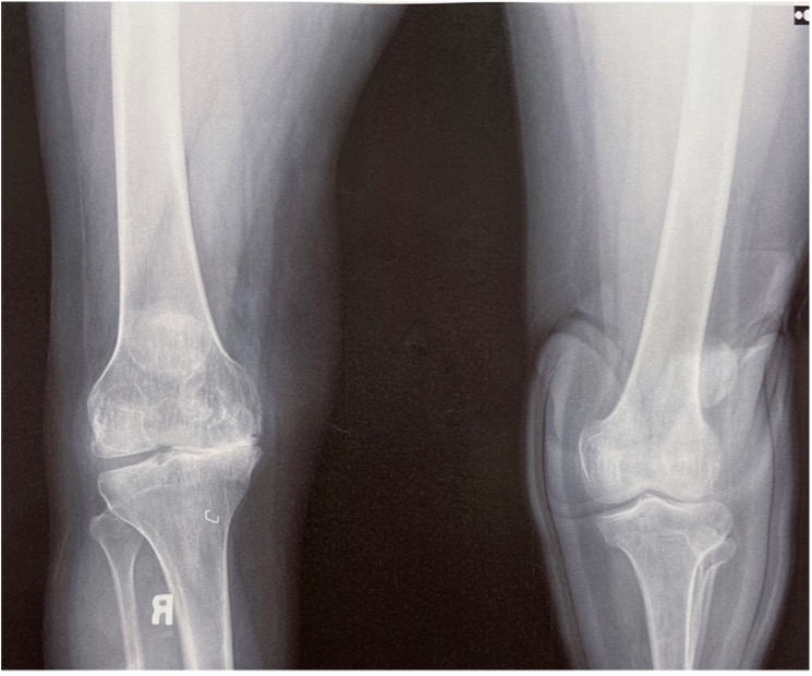 Soft Tissue Expansion in Total Knee Arthroplasty Due to Extensive
